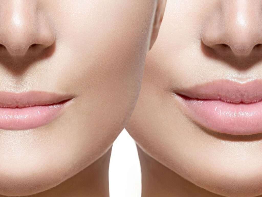 Подтяжка губ. Красивая форма губ. Идеальная форма губ. Идеальная форма губ для женщин.